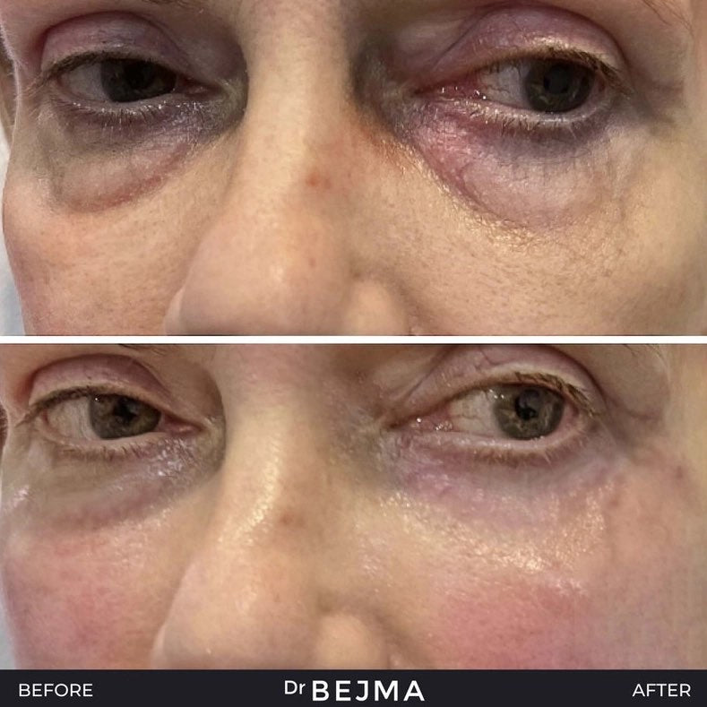 Polynucleotides (Face & Under Eyes)
