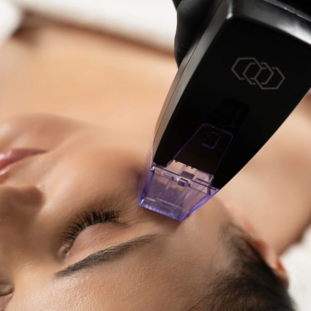 Morpheus8 Radiofrequency Microneedling