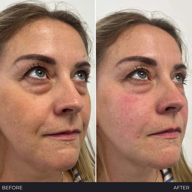 Polynucleotides (Face & Under Eyes)