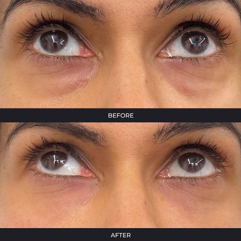 Polynucleotides (Face & Under Eyes)