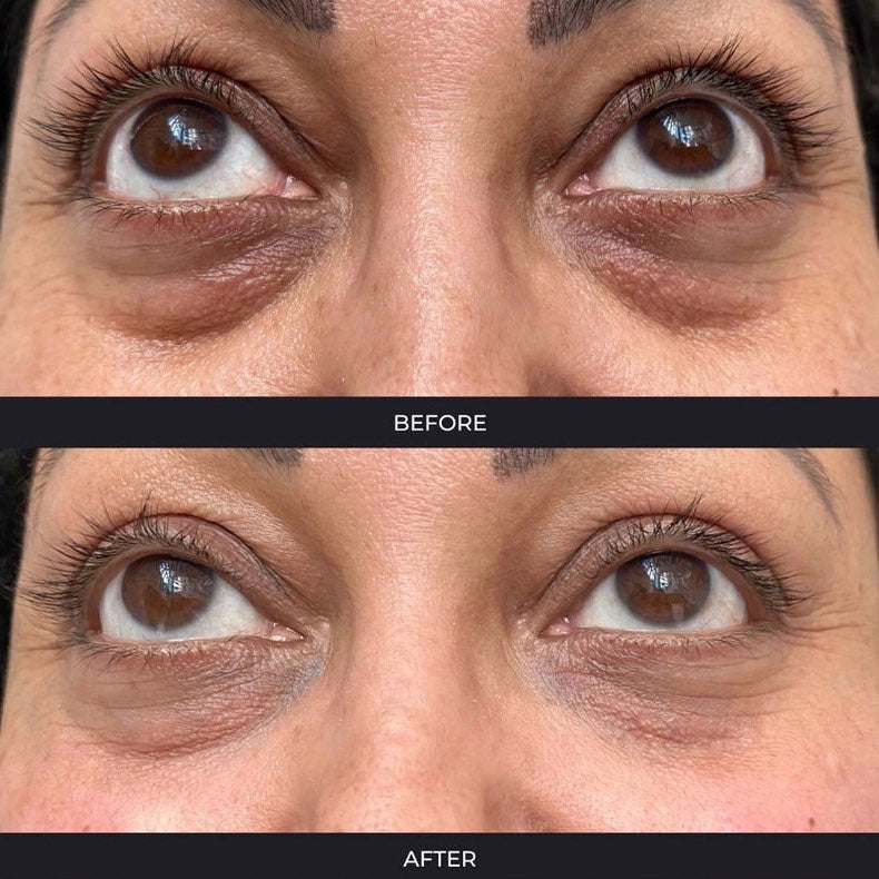 Polynucleotides (Face & Under Eyes)