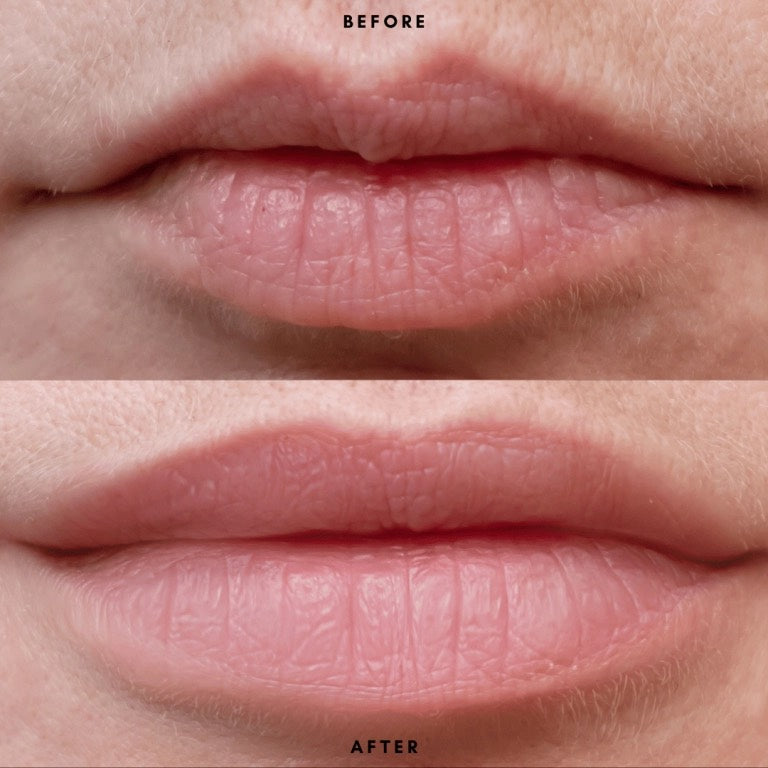 Dermal Lip Filler