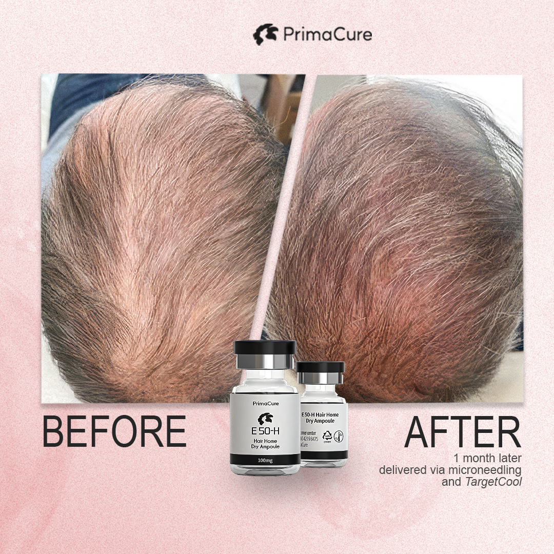 Exosome Hair Rejuvenation