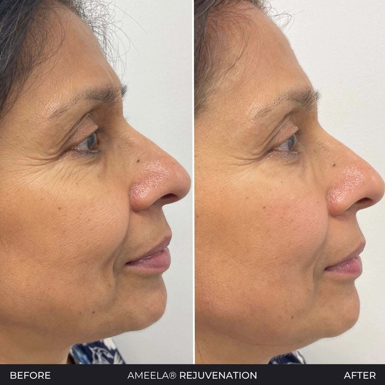 Polynucleotides (Face & Under Eyes)