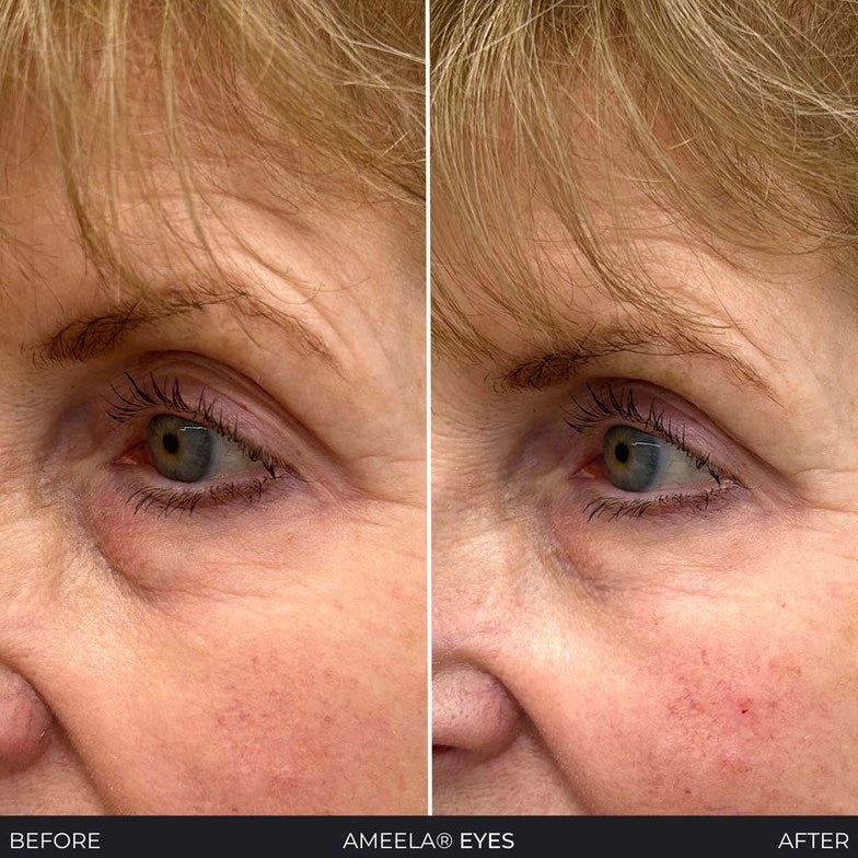 Polynucleotides (Face & Under Eyes)