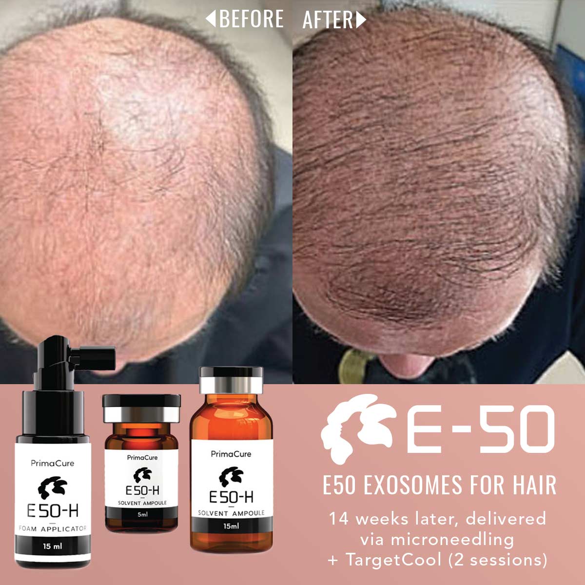 Exosome Hair Rejuvenation