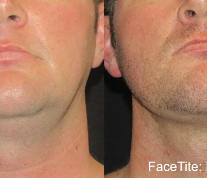 FaceTite Radiofrequency Non-Surgical Facelift