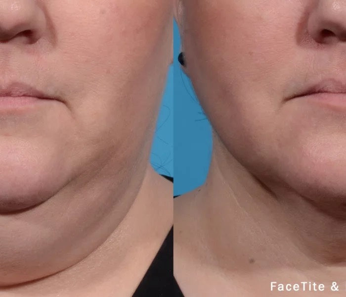 FaceTite Radiofrequency Non-Surgical Facelift