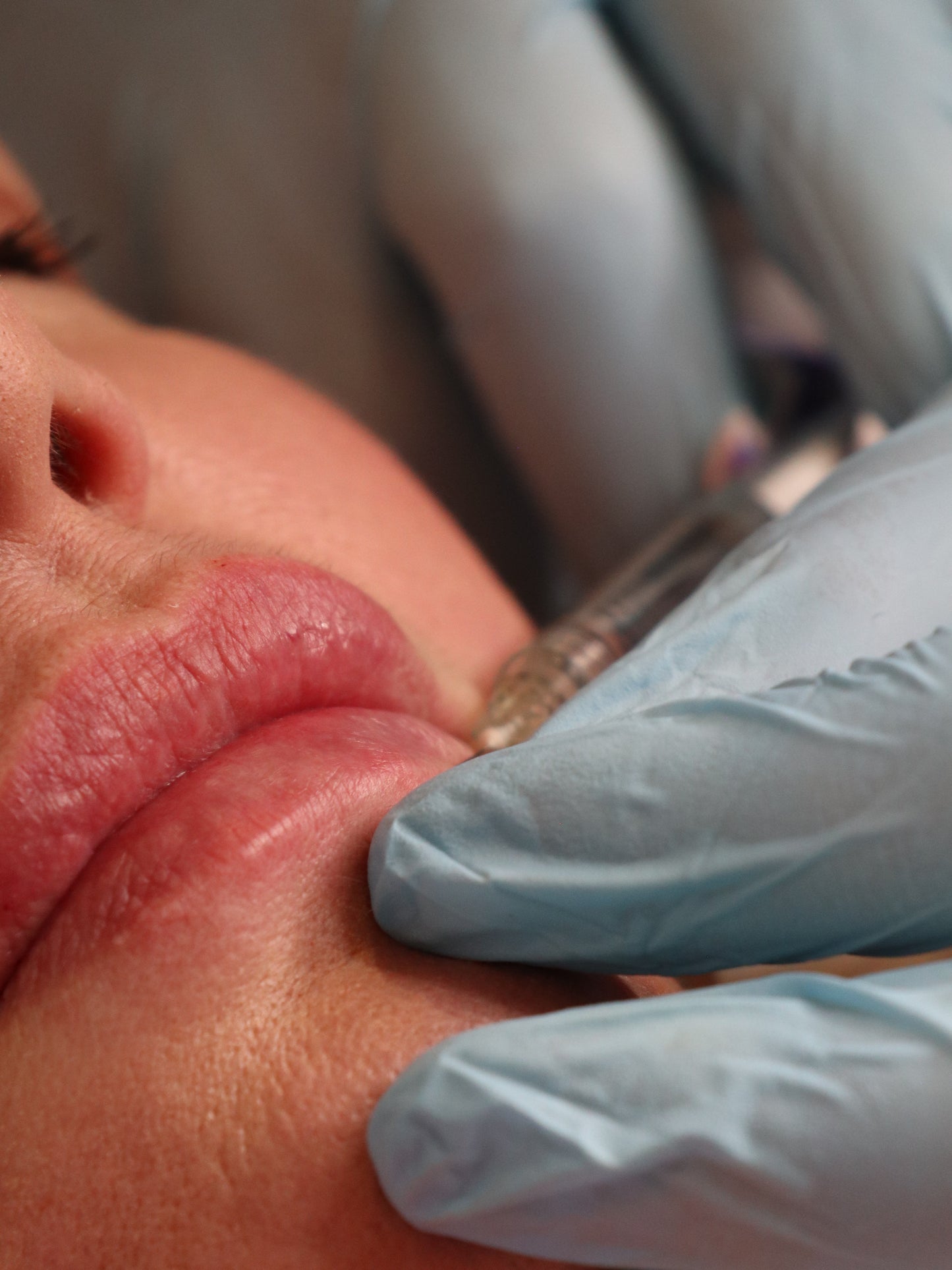 Dermal Lip Filler