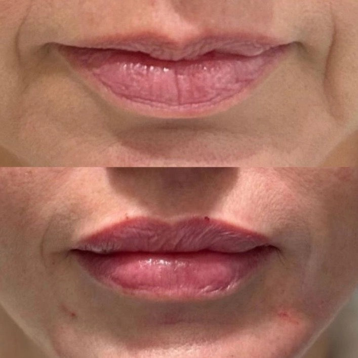 Dermal Lip Filler