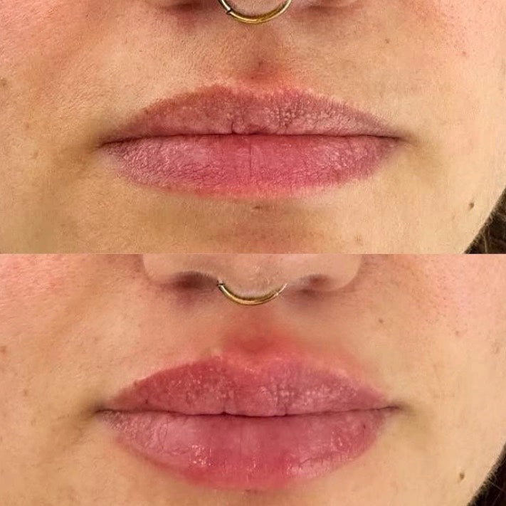 Dermal Lip Filler
